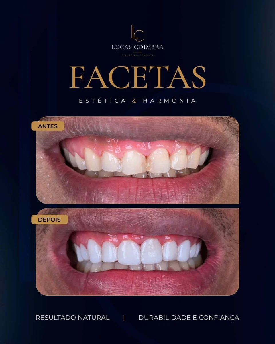 Registro clínico de facetas realizado pelo Dr. Lucas Coimbra